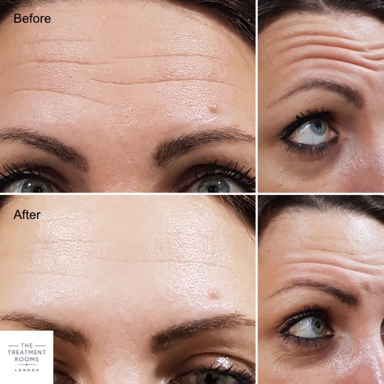 Anti-Wrinkle Injections Forehead Lines